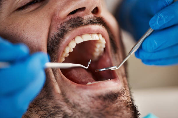 Best Emergency Wisdom Teeth Removal in South Miami, FL